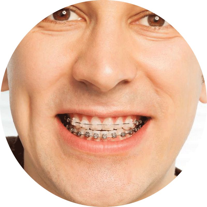 Ortodonzia Adulto